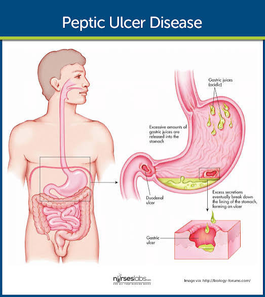 Peptic Ulcer